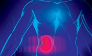 kidney trade in Iran