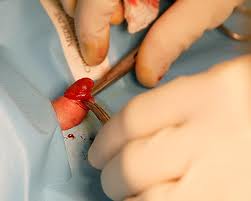 Boys' circumcisions