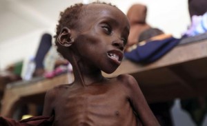 malnourished child