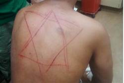 Star of David carved into Alaa Alsaegh's back