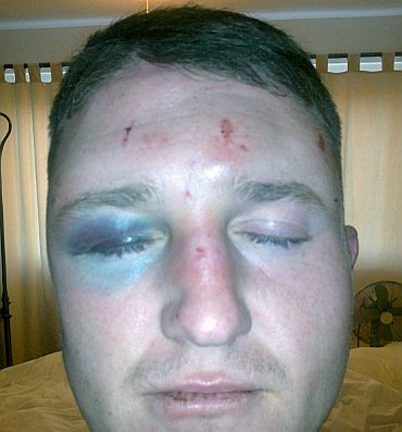 tommy bruised