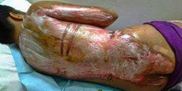 Filipino maid was bathed with boiling water by her Saudi bosss mother